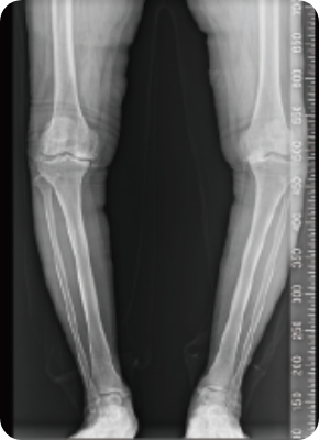 수술 전 X-ray